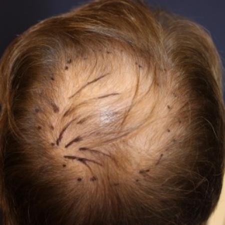 Before Case #87391 - Hair Transplantation San Diego