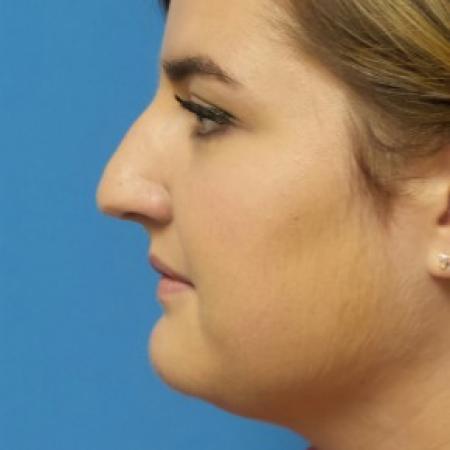 Before image 3 Case #86551 - Rhinoplasty  3 months post-op