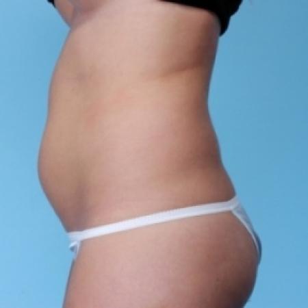 Before image 3 Case #79281 - Non-Surgical
