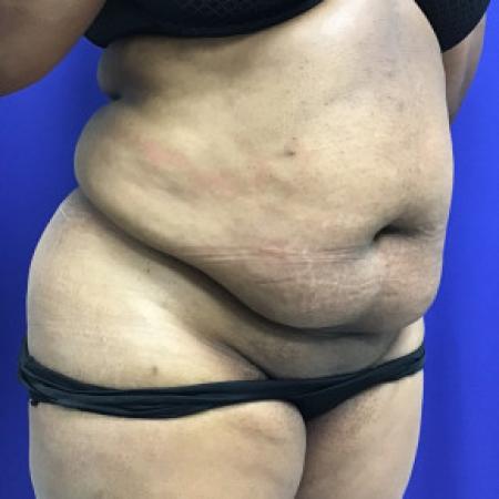 Before image 2 Case #88281 - Tummy Tuck and Liposuction