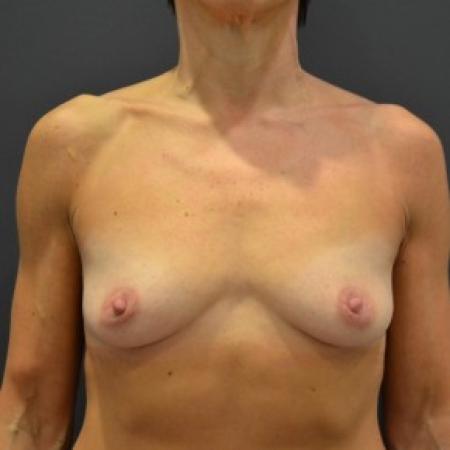 Before image 1 Case #85781 - Breast Augmentation 