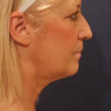 Before image 2 Case #86251 - Balanced face after facelift