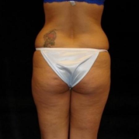 Before image 5 Case #80456 - Buttocks Augmentation Via Fat Grafting with Liposuction of Abdomen, Waist, Flanks, Outer Thighs, and Mini Tummy Tuck