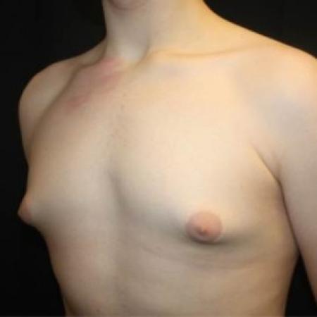 Before image 2 Case #84536 - Gynecomastia - 17 year old male