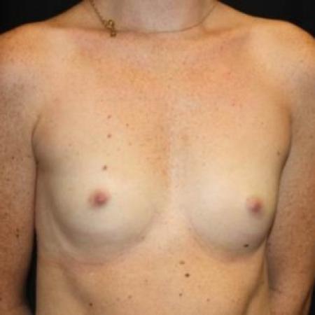 Before image 2 Case #85011 - Breast Augmentation - 26 year old female