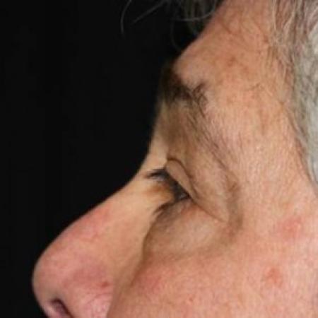 Before image 3 Case #84216 - Blepharoplasty - 61 year old male