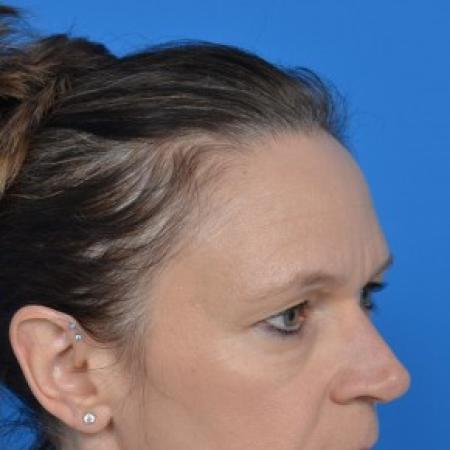 Before image 2 Case #87891 - Upper Eyelid Surgery (blepharoplasty)