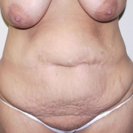 Before image 1 Case #82806 - Abdominoplasty