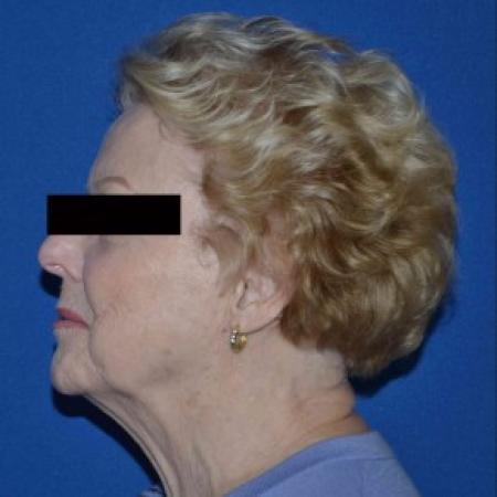 Before image 2 Case #86796 - Full Facelift