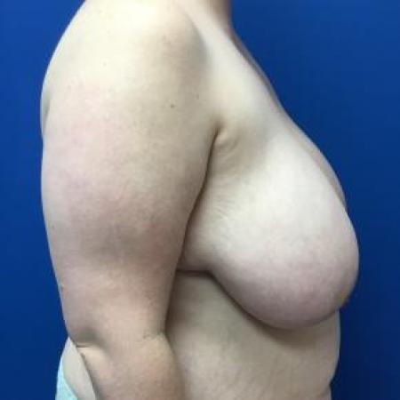 Before image 2 Case #88376 - Breast Reduction on a 28 year old female 
