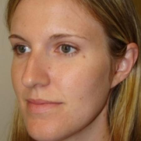Before image 2 Case #79551 - Rhinoplasty