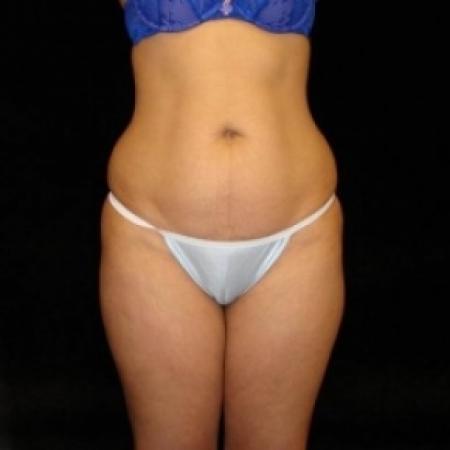 Before image 1 Case #80456 - Buttocks Augmentation Via Fat Grafting with Liposuction of Abdomen, Waist, Flanks, Outer Thighs, and Mini Tummy Tuck