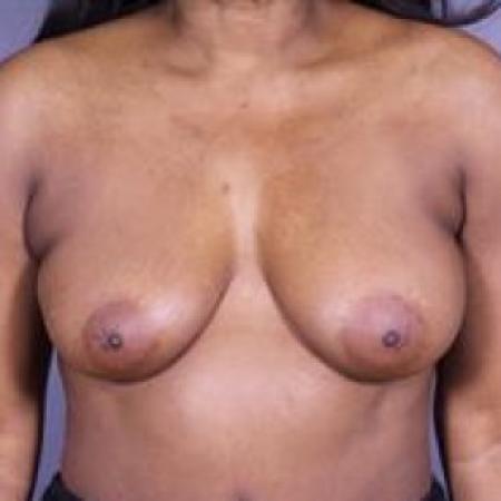 Before image 1 Case #84726 - Vertical Mastopexy