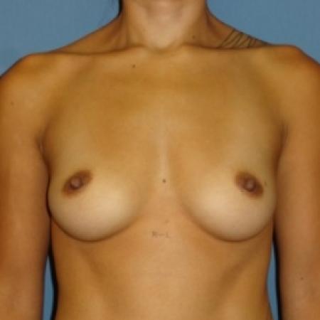 Before image 1 Case #80691 - Breast Augmentation