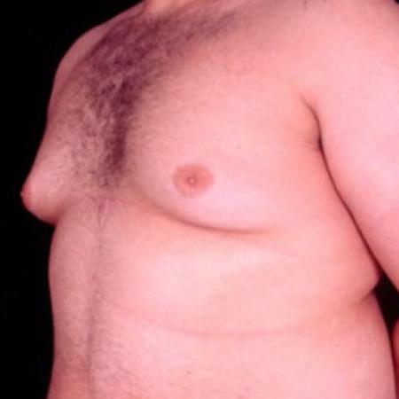 Before image 2 Case #81511 - Gynecomastia