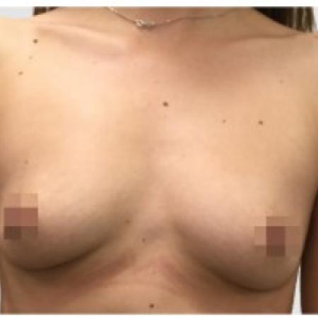 Before image 1 Case #86981 - Breast Augmentation