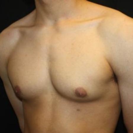Before image 2 Case #85276 - Gynecomastia - 17 year old male 