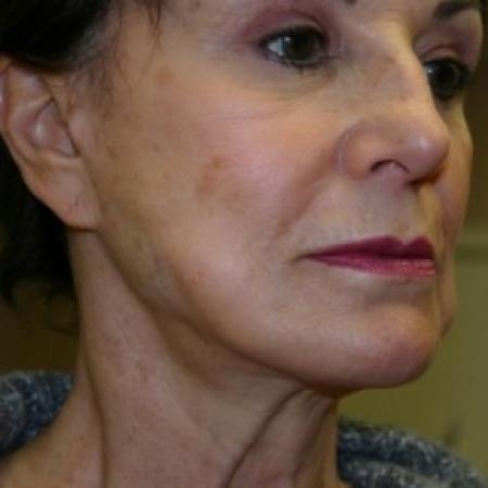 Before image 3 Case #81101 - Facelift