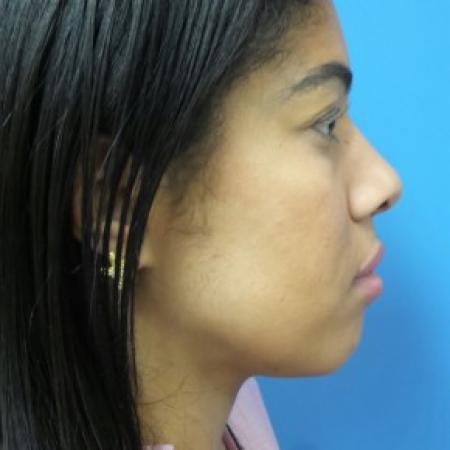 Before image 2 Case #86446 - Rhinoplasty - 3 months post-op
