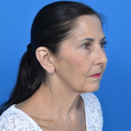 Before image 2 Case #88061 - Facelift and Neck Lift