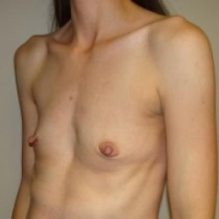 Before image 2 Case #79436 - Breast Augmentation