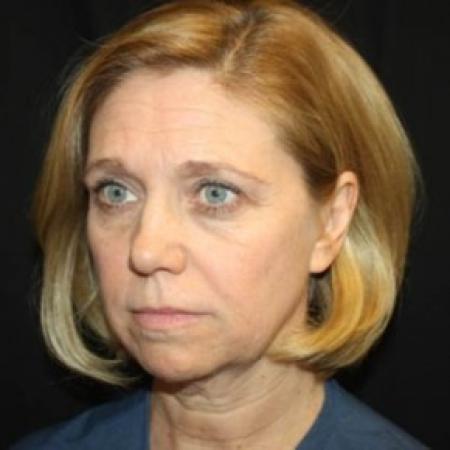 Before image 2 Case #83761 - Facelift - 49 year old female.