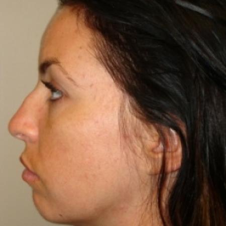 Before image 3 Case #80476 - Open Rhinoplasty