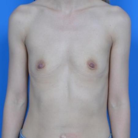 Before image 1 Case #87821 - Breast Augmentation with Sientra 315cc moderate-high profile smooth round gel implants.