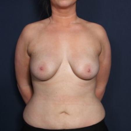 Before image 1 Case #83901 - 22 Year Old Female