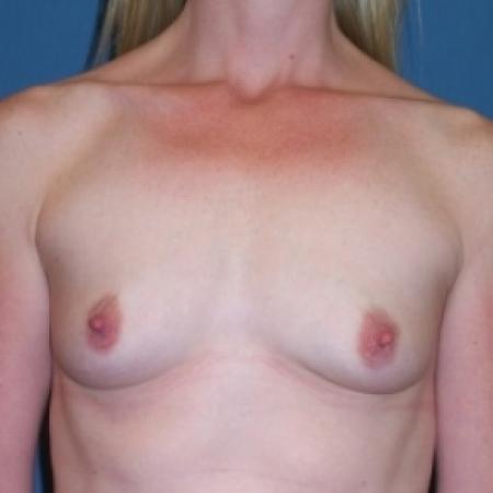 Before image 1 Case #80681 - Breast Augmentation