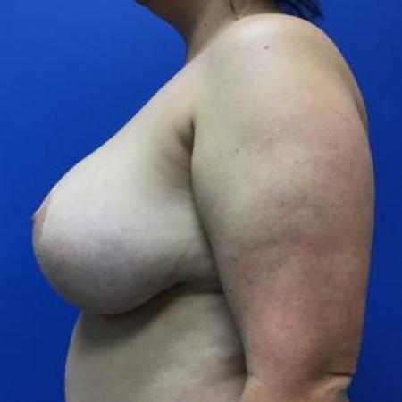 Before image 3 Case #88301 - Implant Removal and Mastopexy on a 34 year old female