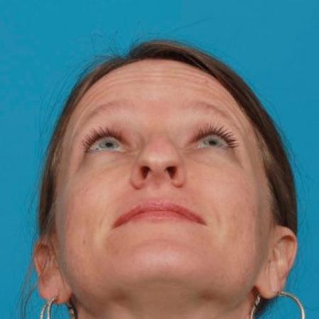 Before image 4 Case #85711 - Open Septorhinoplasty