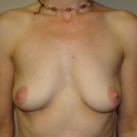 Before image 1 Case #79431 - Breast Augmentation