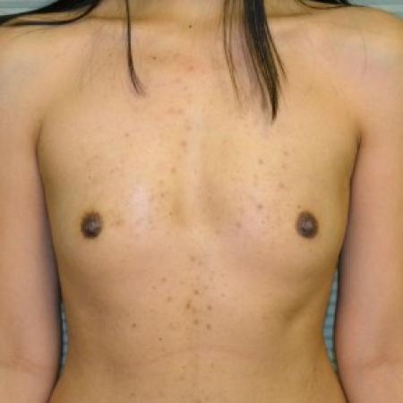 Before image 1 Case #87781 - Breast Augmentation with Mentor Memorygel 325cc high profile smooth round gel