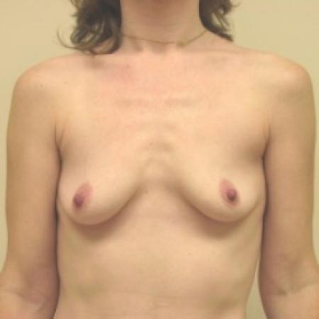 Before image 1 Case #81026 - Breast Augmentation