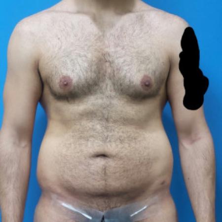 Before Case #88451 - Circumferential Body Lift /Gynecomastia Reduction