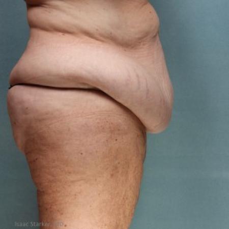 Before image 2 Case #86821 - After Weight Loss Body Contouring Panniculectomy