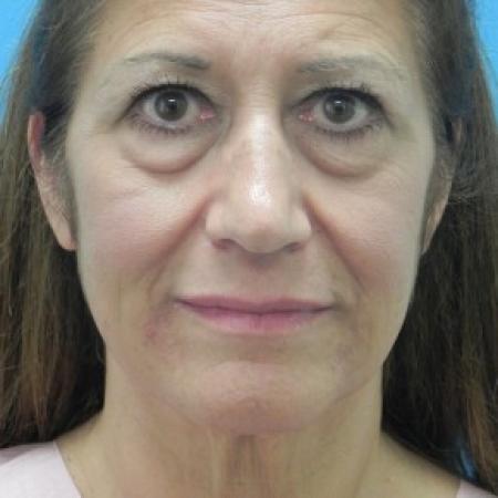 Before image 1 Case #86606 - Facelift/Upper & Lower Blepharoplasty/Browlift    14 months post-op