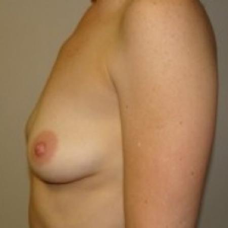 Before image 3 Case #79431 - Breast Augmentation