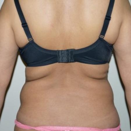 Before image 1 Case #82376 - Ultrasonic liposuction back