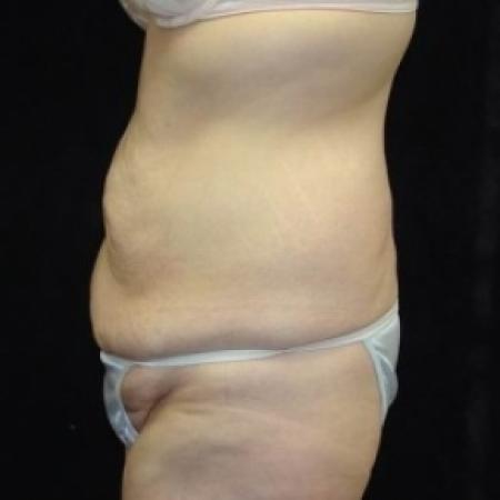 Before image 3 Case #80226 - Circumfrential Abdominoplasty with Liposuction of Abdomen, Waist, and Flanks
