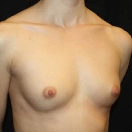 Before image 2 Case #85241 - Breast Augmentation - 24 year old female