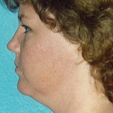 Before image 2 Case #79196 - Liposuction