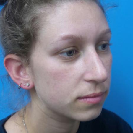Before image 2 Case #88391 - 25 year old  -  Rhinoplasty/Septoplasty/Partial Turbinectomy  -  7 months post-op