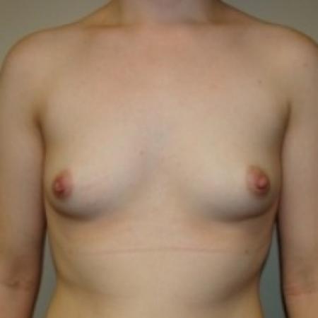 Before image 1 Case #79721 - Breast Augmentation