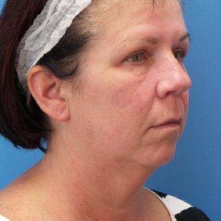 Before image 2 Case #86566 - Facelift/Lower Blepharoplasty/Browlift/Laser Resurfacing to Full Face     4 months post-op