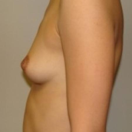 Before image 3 Case #79391 - Breast Augmentation