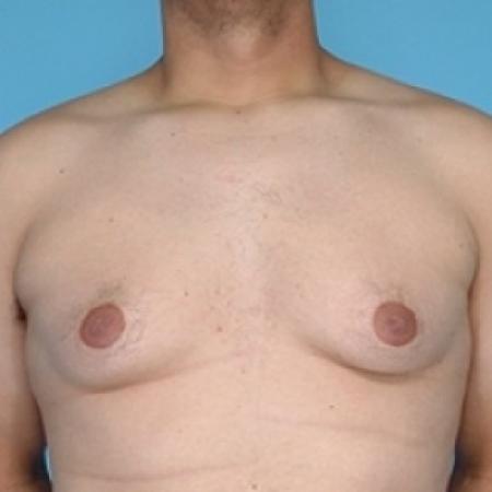 Before image 1 Case #79271 - Male Breast Reduction