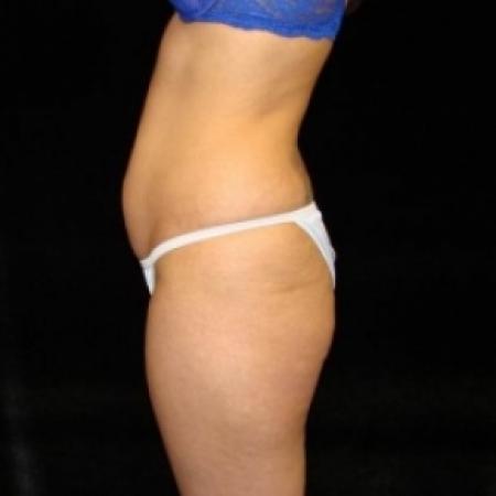 Before image 3 Case #80456 - Buttocks Augmentation Via Fat Grafting with Liposuction of Abdomen, Waist, Flanks, Outer Thighs, and Mini Tummy Tuck
