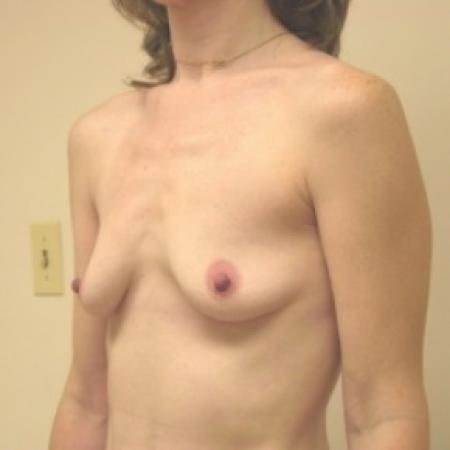 Before image 2 Case #81026 - Breast Augmentation
